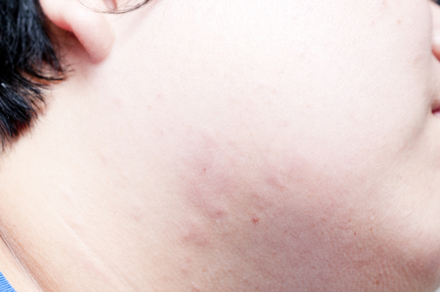 虫刺されみたいな腫れ 顔 蚊に刺されたような腫れが突然できる原因は何？痒くない場合は？